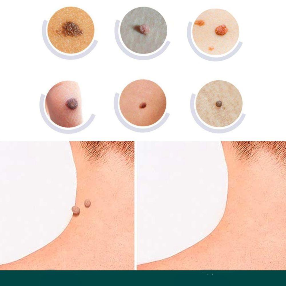 Hydrocolloid Blemish Removal Stickers for Sensitive Skin - Invisible Waterproof Patches for Neck, Hands & Body Care | Lonoma