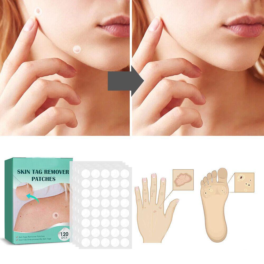 Hydrocolloid Blemish Removal Stickers for Sensitive Skin - Invisible Waterproof Patches for Neck, Hands & Body Care | Lonoma