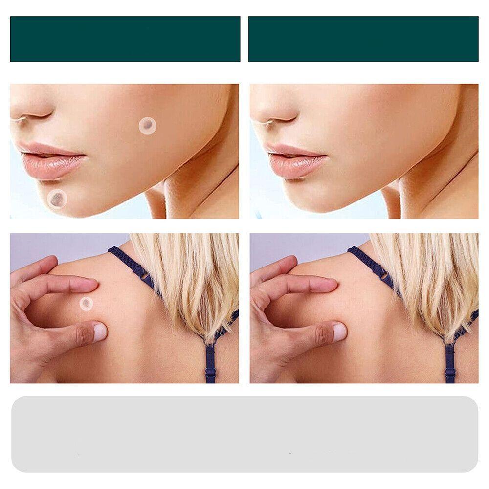 Hydrocolloid Blemish Removal Stickers for Sensitive Skin - Invisible Waterproof Patches for Neck, Hands & Body Care | Lonoma